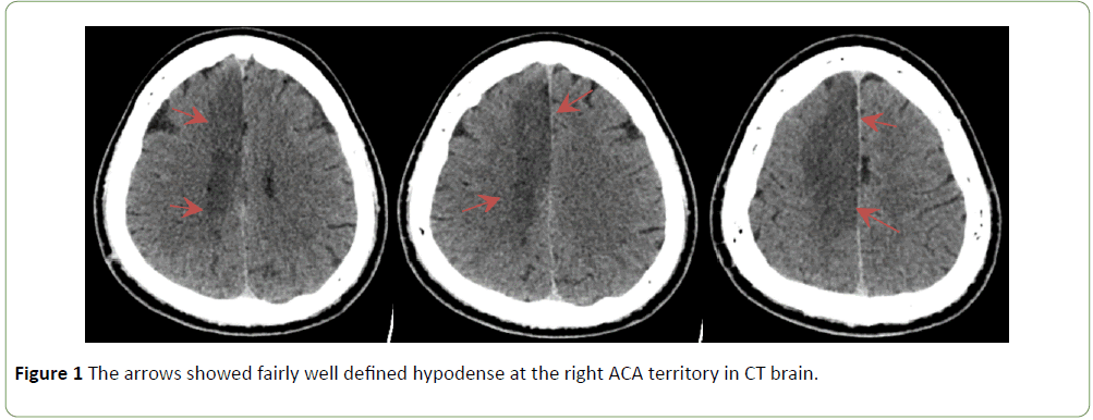Neurology-Neuroscience-defined-hypodense