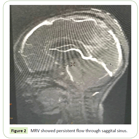 Neurology-Neuroscience-saggital-sinus