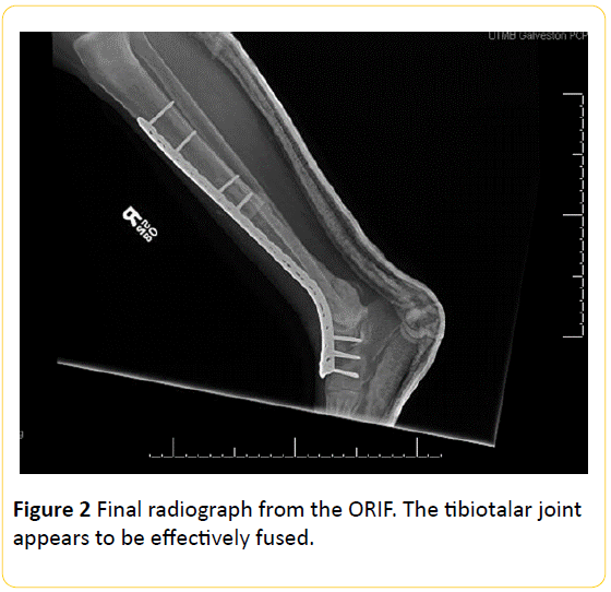 Translational-Biomedicine-Final-radiograph-tibiotalar