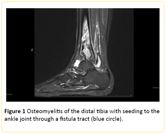 Translational-Biomedicine-Osteomyelitis-distal-tibia