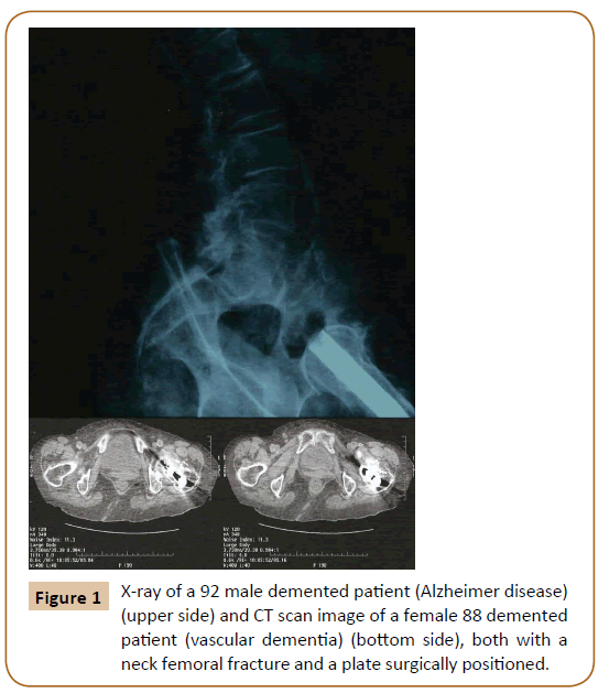 Universal-Surgery-Alzheimer-disease