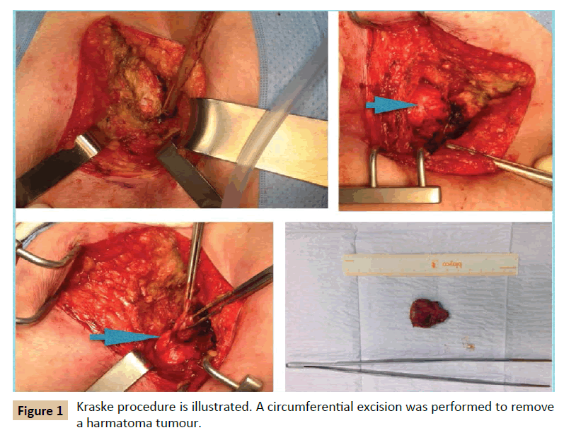 Universal-Surgery-Kraske-procedure-illustrated