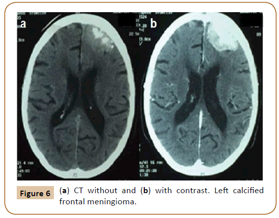 Universal-Surgery-Left-calcified