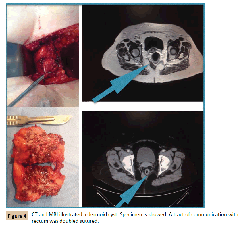 Universal-Surgery-MRI-illustrated-dermoid-cyst