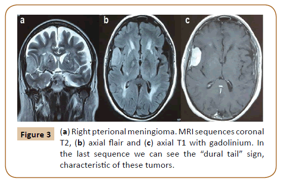 Universal-Surgery-Right-pterional-meningioma