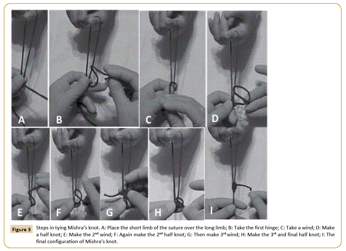 Universal-Surgery-Steps-tying-Mishras-knot