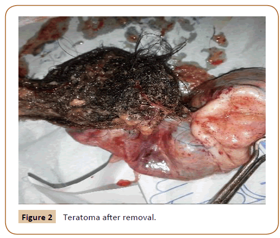 Universal-Surgery-Teratoma