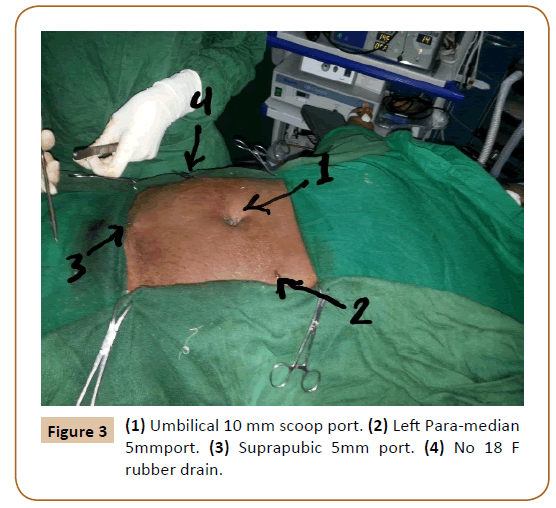 Universal-Surgery-Umbilical