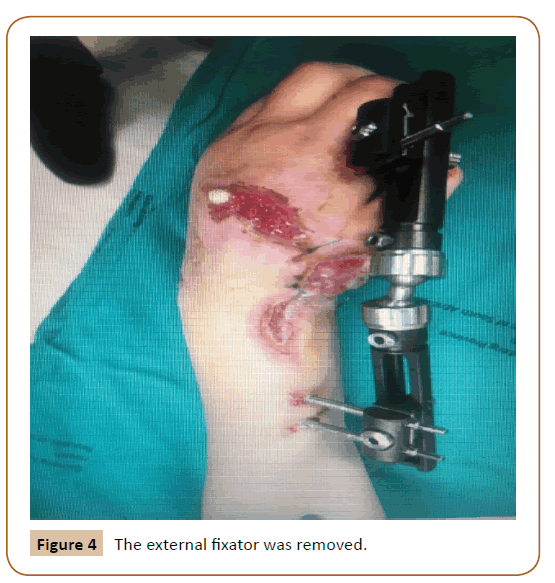 Universal-Surgery-external-fixator