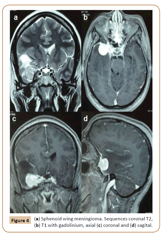 Universal-Surgery-meningioma