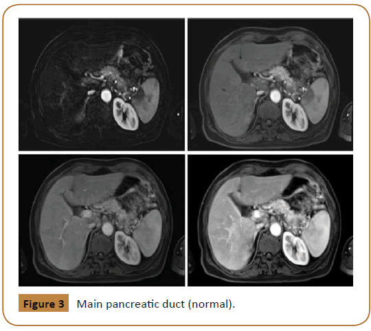 Universal-Surgery-pancreatic-duct