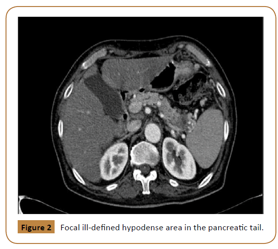 Universal-Surgery-pancreatic-tail