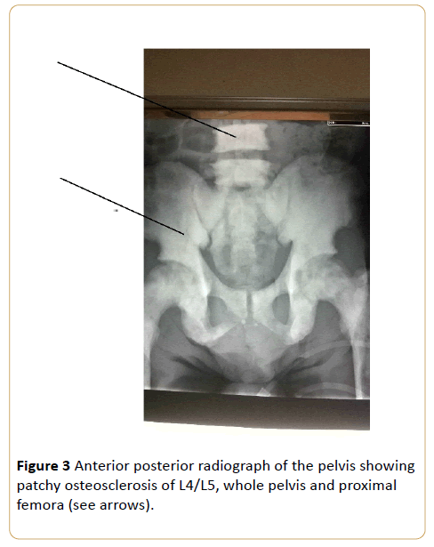 acanceresearch-Anterior-posterior-radiograph