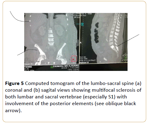 acanceresearch-Computed-tomogram-lumbo-sacral-spine
