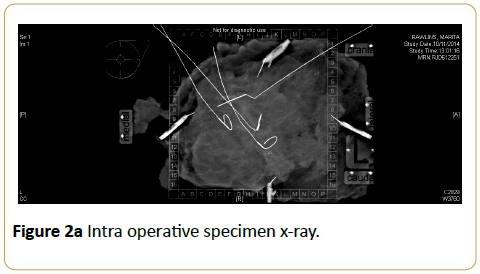 acanceresearch-Intra-operative-specimen