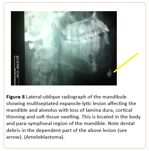 acanceresearch-Lateral-oblique-radiograph