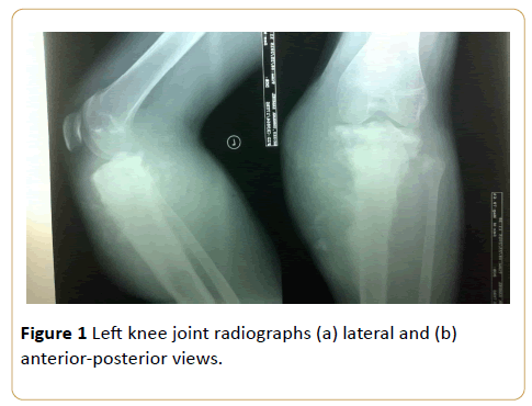 acanceresearch-Left-knee-joint-radiographs
