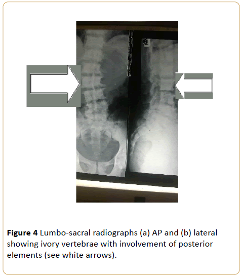 acanceresearch-Lumbo-sacral-radiographs