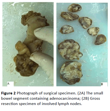 acanceresearch-Photograph-surgical-specimen