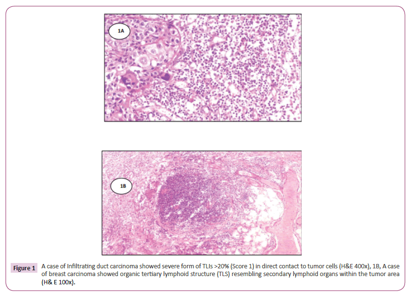 acanceresearch-carcinoma