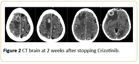 acanceresearch-ct-brain