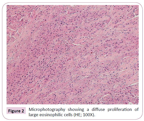 acanceresearch-eosinophilic-cells