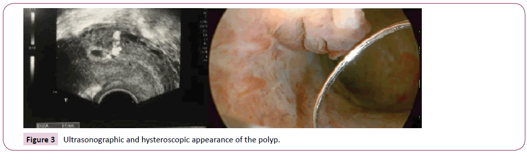 acanceresearch-hysteroscopic