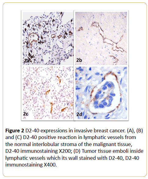 acanceresearch-invasive-breast-cancer