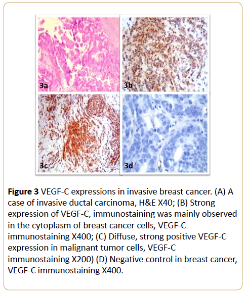 acanceresearch-invasive-ductal-carcinoma