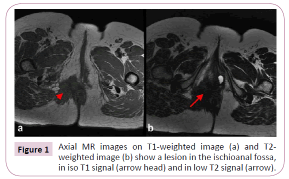 acanceresearch-ischioanal-fossa