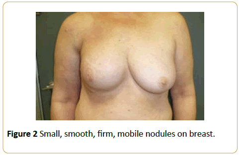 acanceresearch-mobile-nodules-breast