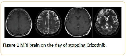 acanceresearch-mri-brain