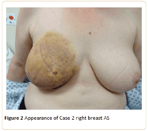 acanceresearch-right-breast