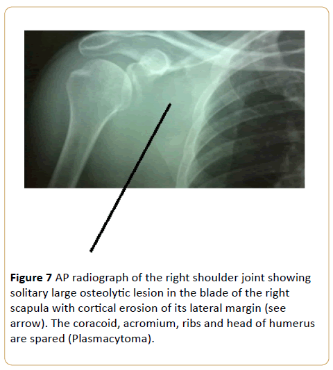 acanceresearch-solitary-large-osteolytic-lesion