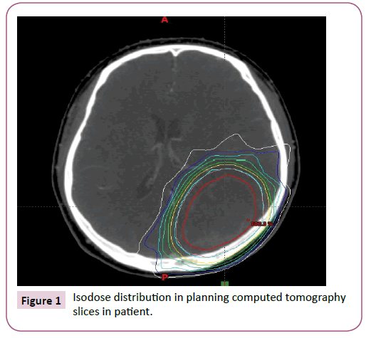 acanceresearch-tomography