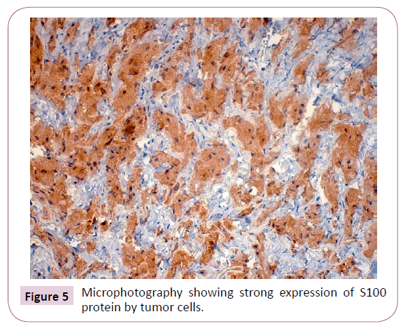 acanceresearch-tumor-cells