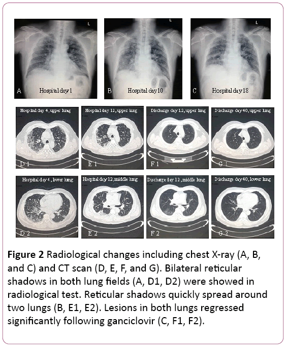 aclr-chest-X-ray-CT-scan