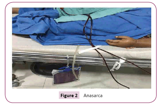 acmicrob-anasarca