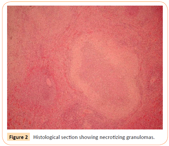 acmicrob-necrotizing-granulomas