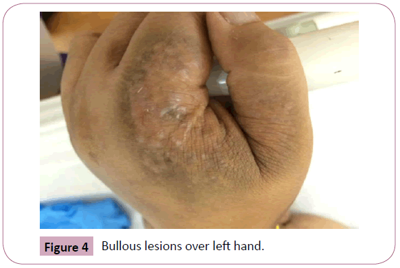 annals-clinical-laboratory-Bullous-lesions