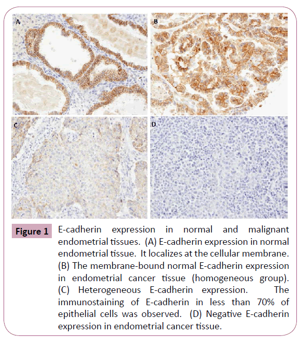 annals-clinical-laboratory-E-cadherin-expression