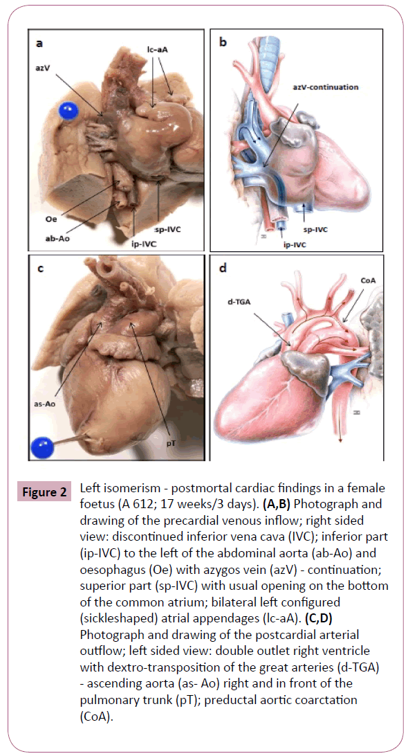 annals-clinical-laboratory-Left-isomerism