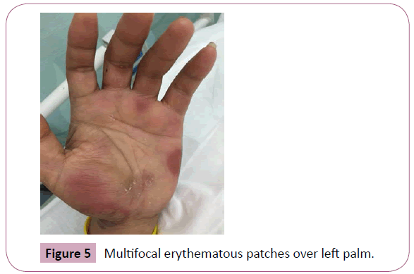 annals-clinical-laboratory-Multifocal-erythematous