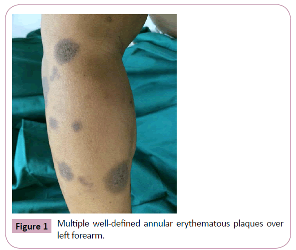 annals-clinical-laboratory-annular-erythematous