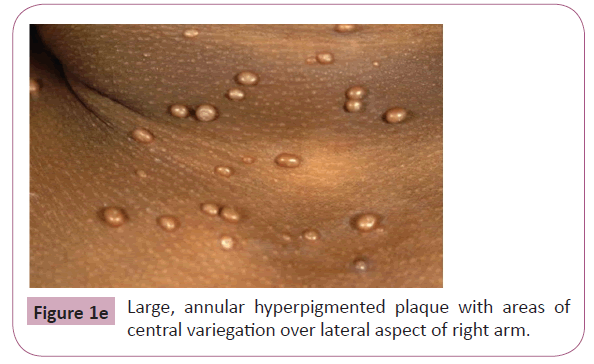 annals-clinical-laboratory-annular-hyperpigmented