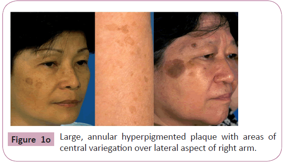 annals-clinical-laboratory-annular-hyperpigmented