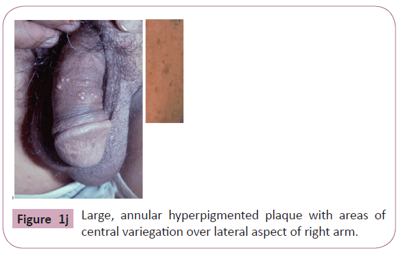 annals-clinical-laboratory-central-variegation