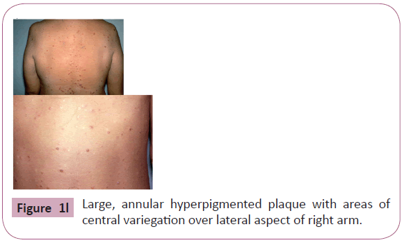 annals-clinical-laboratory-central-variegation