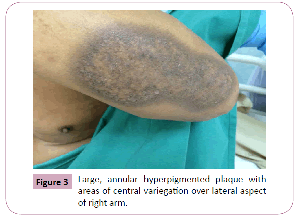 annals-clinical-laboratory-hyperpigmented-plaque