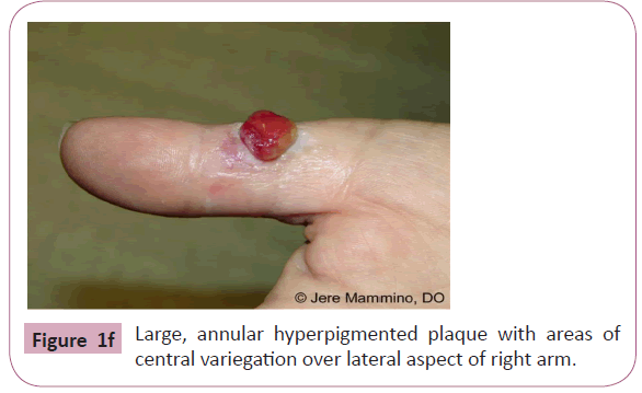 annals-clinical-laboratory-hyperpigmented-plaque
